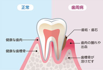 正常な状態と歯周病の状態