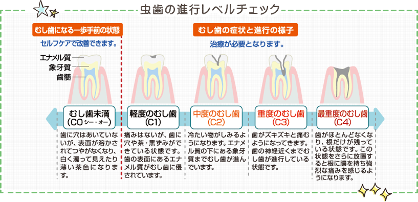 虫歯の進行レベルチェック