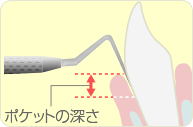 歯周ポケットの深さ