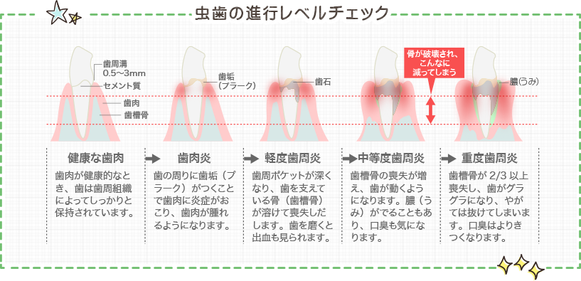 虫歯の進行レベルチェック