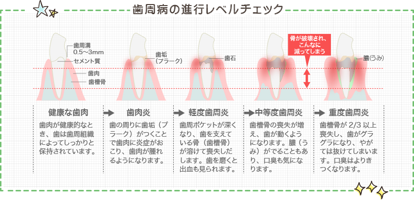 歯周病の進行レベルチェック