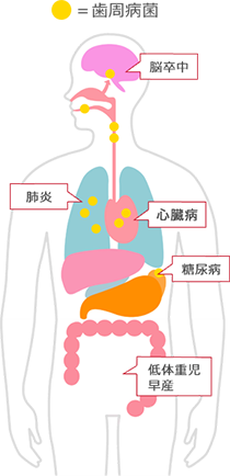 歯周病と全身疾患との関係